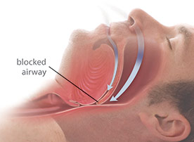 Obstructive Sleep Apnea (OSA) Diagram